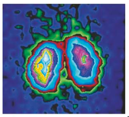 PHOTO GAMMA CAMERA KIDNEY